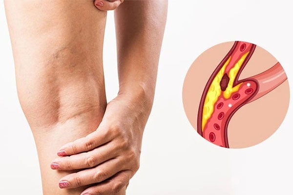 damar-tıkanıklık-hastalıkları